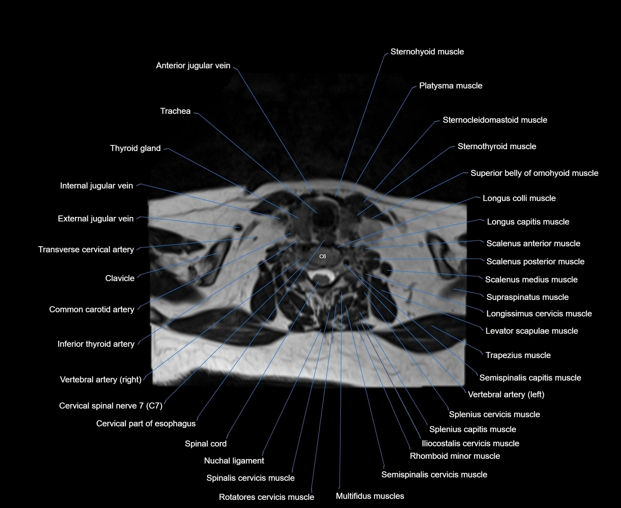 MRI Neck 3D labelled cross section anatomy axial 3t image-00001-00070.webp